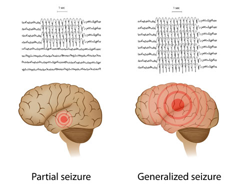 Ketogenic Diet and Epilepsy Can the Ketogenic Diet Help Patients with Epilepsy?